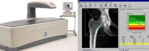  Bone-Fracture